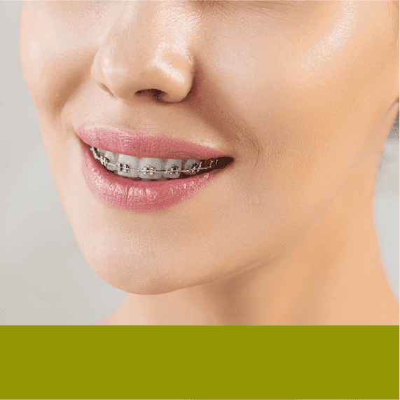 Dental Braces | Plaza Dental