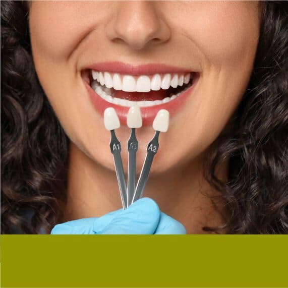 Dental veneers | LA Plaza Dental