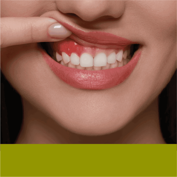 Non-Surgical Gum Disease Treatment | Plaza Dental
